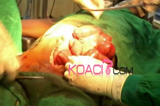 Côte d'Ivoire: 3 trois brosses à  dent découvertes dans un ventre lors d'une opération